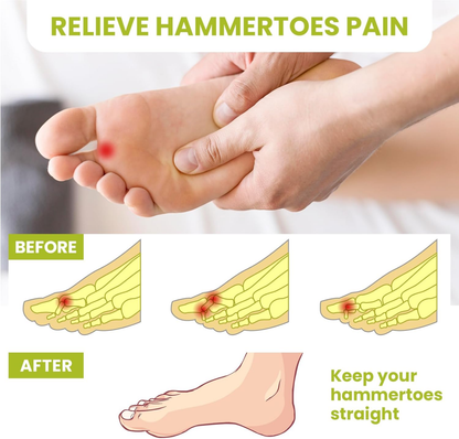 Bukihome Hammertoe Straighteners
